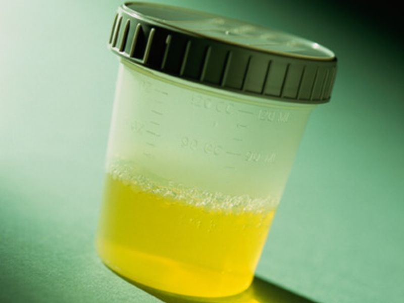 Ceruloplasmin ID'd As Marker of Kidney Disease in Sickle Cell