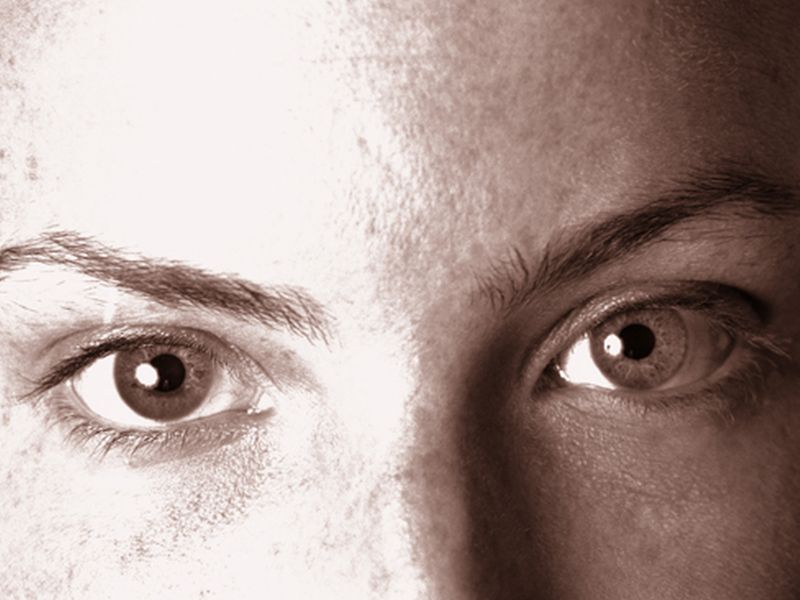 Addition of Peel to Microneedling Improves Acne Scar Treatment