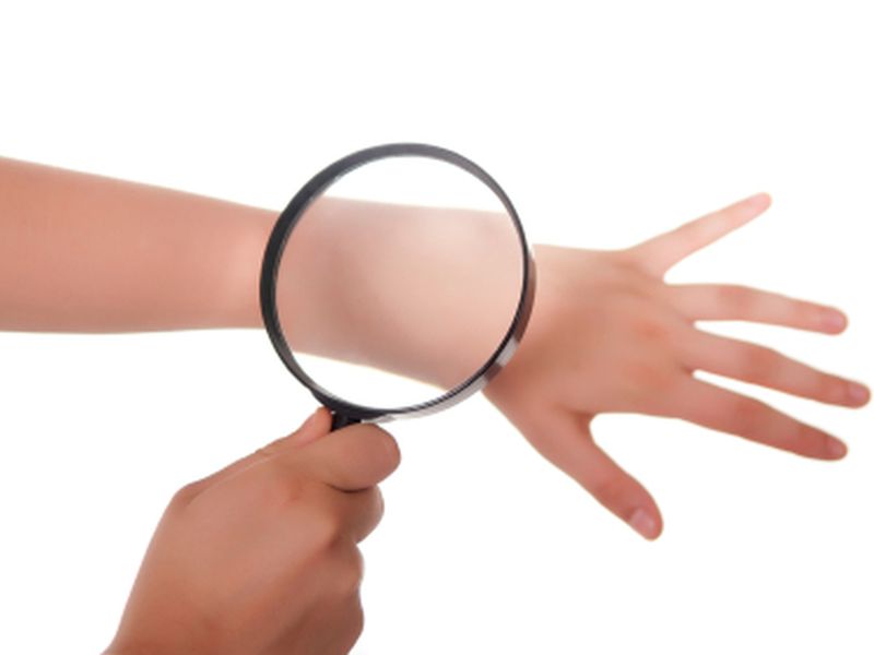 Most Melanomas Don't Start As Existing Moles