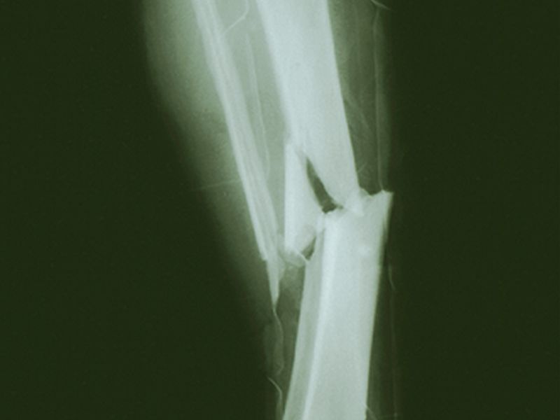 Effect of Osteoporotic Fractures Similar to Diabetes Burden