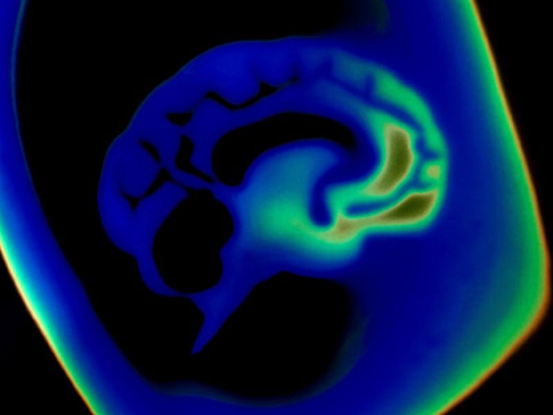 Alcohol Aids Cerebellar Deficit From Movement Disorder